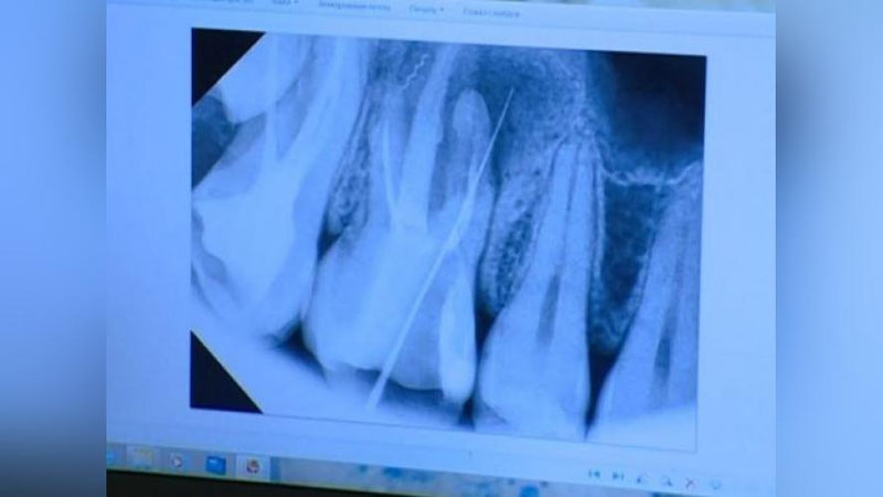 Изрображение 'ЛЖЕ-СТОМАТОЛОГ ИЗ ХОРЕЗМА ОСТАВИЛ ОБЛОМОК ИГЛЫ В ЗУБЕ ПАЦИЕНТКИ'