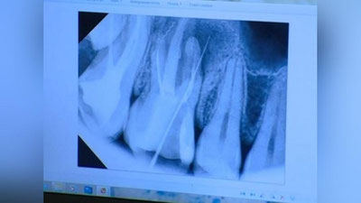 Изрображение 'ЛЖЕ-СТОМАТОЛОГ ИЗ ХОРЕЗМА ОСТАВИЛ ОБЛОМОК ИГЛЫ В ЗУБЕ ПАЦИЕНТКИ'