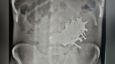 Изрображение 'ИНДИЕЦ СЪЕЛ 116 ГВОЗДЕЙ И ВЫЖИЛ'