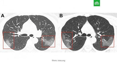 Изрображение 'Медики показали снимки пораженных коронавирусом легких 33-летней пациентки'