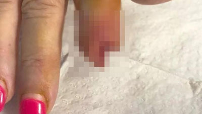 Изрображение 'АВСТРАЛИЙКА ЛИШИЛАСЬ ПАЛЬЦА ПОСЛЕ МАНИКЮРА'