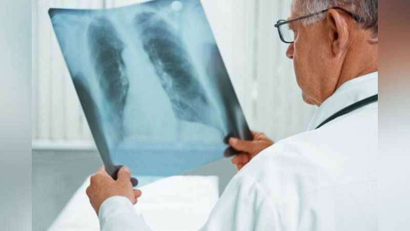 'O`zbekistonda tuberkulyoz bilan kasallangan 18 ming bemor dori bilan ta`minlanadi'ning rasmi