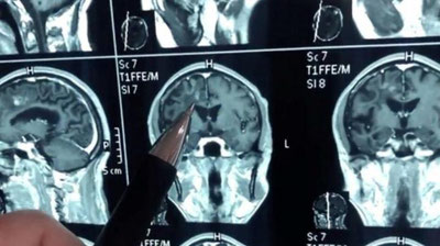 Изрображение 'Китаец тридцать лет жил с живым червем в мозгу (видео)'