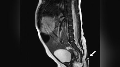 Изрображение 'В Мексике родилась девочка с шестисантиметровым хвостом'