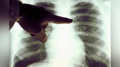 'Kecha O`zbekistonda  479 nafar kishida pnevmoniya aniqlandi'ning rasmi