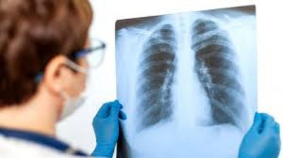 'Pnevmoniya bo`yicha kunlik ko`rsatkichlar ma`lum qilindi'ning rasmi