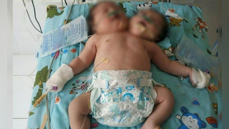 'Samarqandda tug`ilgan ikki boshli chaqaloqdan uning oilasi voz kechdi (video)'ning rasmi
