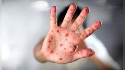 'ЖССТ: Дунёда қизамиқ касаллиги кенг тарқалмоқда'ning rasmi