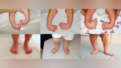 'O`zbekistonda tug`ma maymoqlik yangi usulda, tez va samarali davolanmoqda — SSV'ning rasmi