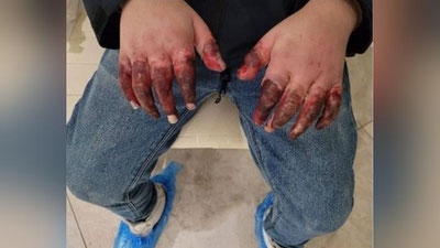 'Moskvada o`zbekistonlik erkak 7 yoshli o`gay o`g`lini barmoqlari kesib tashlanadigan darajada qiynoqqa solgan bo`lishi mumkin'ning rasmi