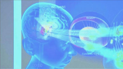 'Parkinson kasalligini davolashda yangi amaliyot qo`llanildi'ning rasmi