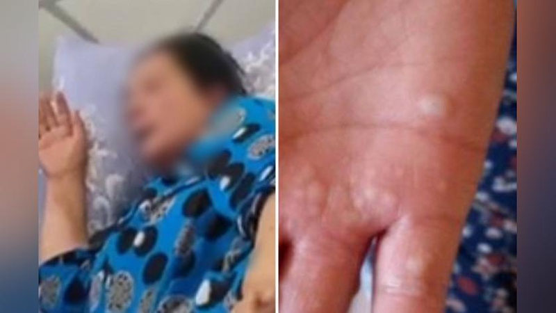 'Андижонда маймунчечакка чалиниш ҳолати қайд этилгани ҳақида хабар тарқалди'ning rasmi