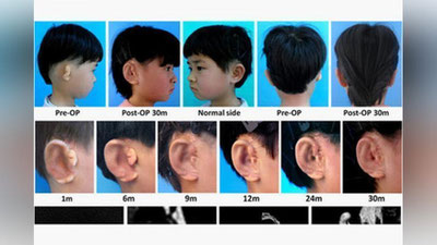 'Хитойликлар болалар учун қулоқ  ўстиришмоқда 'ning rasmi