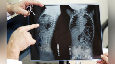 ' Танасидан 16та игна топилган боланинг аҳволи ҳақида шифокор маълумот берди'ning rasmi