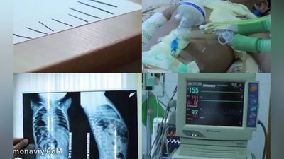 'Танасидан 16 та игна топилган гўдак иши бўйича жиноят иши қўзғатилди'ning rasmi