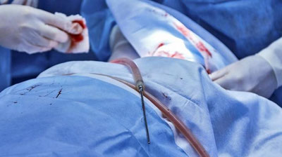 Изрображение 'ИТАЛЬЯНСКИЙ ХИРУРГ ЗАЯВИЛ ОБ УСПЕШНОЙ ПЕРЕСАДКЕ ЧЕЛОВЕЧЕСКОЙ ГОЛОВЫ'