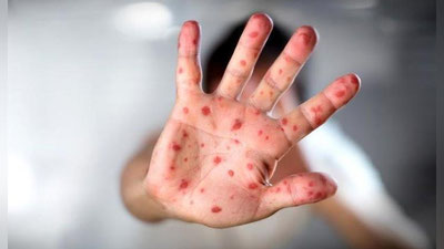 'Samarqandda qizamiq epidemiyasi tarqalgani rostmi?'ning rasmi