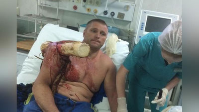 'Tanasini yog`och xoda teshib ketgan erkak selfiga tushdi (foto)'ning rasmi