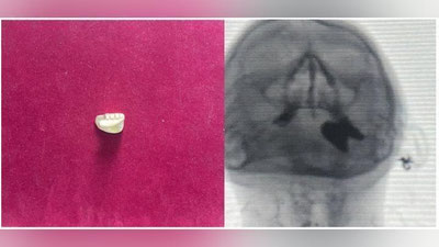 'Noodatiy usul: xorijga chiqib ketayotgan fuqaroning tilla tishlari aslida quyma tilla bo`laklari bo`lib chiqdi'ning rasmi