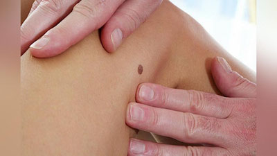 Изрображение 'Можно ли удалять родинки?'