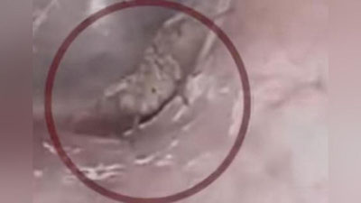 'Bemorning qulog`iga kirib olgan o`rgimchak to`r to`qidi (Video) 'ning rasmi