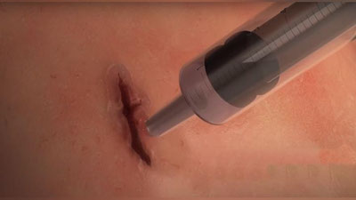 '1 дақиқа ичида ярани боғлаб, битказадиган тиббиёт елими ихтиро қилинди (Видео)'ning rasmi