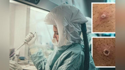 'Maymun chechagi keltirib chiqarayotgan og`ir asoratlar ma`lum qilindi'ning rasmi