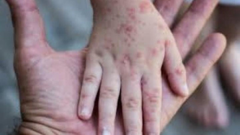 '​JSST maymun chechagi bilan bog`liq epidemiologik vaziyatdan xavotirda'ning rasmi