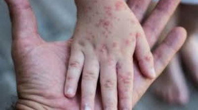 '​JSST maymun chechagi bilan bog`liq epidemiologik vaziyatdan xavotirda'ning rasmi