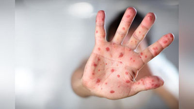 'Yurtimizda qizamiq kasalligi bilan bog`liq noxush vaziyat kuzatildimi?'ning rasmi