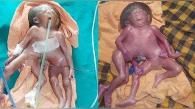 '​Ҳиндистонда 4 қўлли ва 4 оёқли қизча дунёга келди (Видео)'ning rasmi