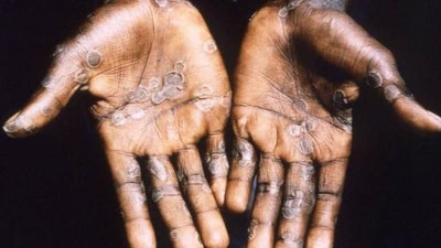 'ЖССТ: Маймун чечагини юқтирган беморлар сони бир ҳафтада 203 фоизга кўпайди'ning rasmi