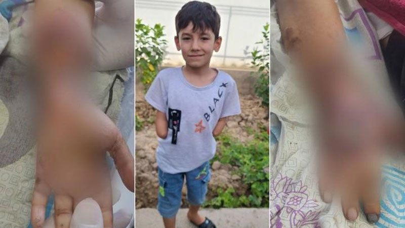 'Qashqadaryoda xavfsizligi ta`minlanmagan transformator sabab 7 yoshli bola ikki qo`lidan ajralib qoldi'ning rasmi