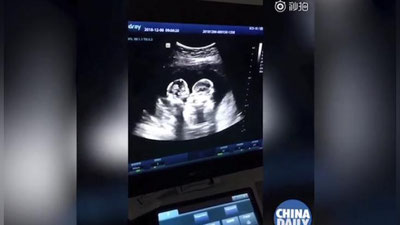 Изрображение '"ДРАКУ" БЛИЗНЕЦОВ В УТРОБЕ МАТЕРИ УВИДЕЛИ НА УЗИ (ВИДЕО)'