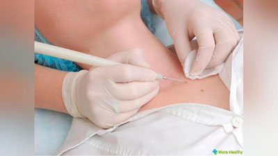 'Shifo maslahat: “PAPILLOMANI YOD BILAN KUYDIRSA BO`LADIMI?”'ning rasmi