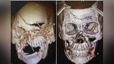 '​АҚШЛИК ЖАРРОҲЛАР ЙТҲГА УЧРАГАН 24 ЁШЛИ ҚИЗНИНГ МИЯ СУЯГИНИ ҚАЙТА ТЕРИШДИ'ning rasmi
