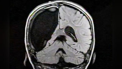 'Миясининг ўнг ярим шари бўлмаган одам  миясининг чап ярми бўлмаган одам билан дўстлашди'ning rasmi