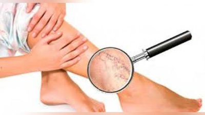 'VARIKOZDA TAVSIYa'ning rasmi