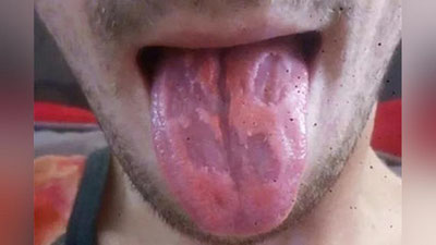 'Avstraliyalik o`qituvchi energetik ichimliklarga qaramligi tufayli tilini kuydirib oldi 'ning rasmi