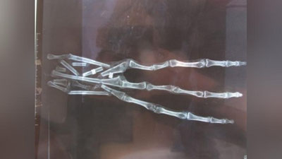 Изрображение 'В ПЕРУ ОБНАРУЖЕНА ЗАГАДОЧНАЯ РУКА С ТРЕМЯ ПАЛЬЦАМИ (ФОТО)'