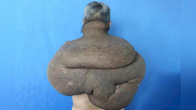 'Mo`ysafid 30 yil davomida elkasida 15 kilogrammli o`simtani ko`tarib yurdi 'ning rasmi