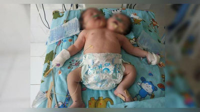 Изрображение 'В Самарканде родились сиамские близнецы с одним телом (видео)'