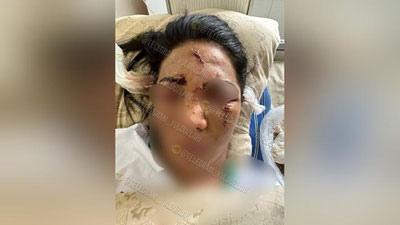 'Qashqadaryoda yigit gaplashishni istamagan qizning yuziga bokal otdi(video)'ning rasmi