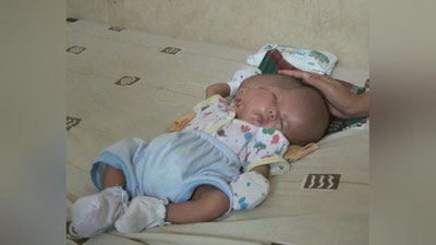 'Indoneziyada ikki yuzli chaqaloq tug`ildi'ning rasmi