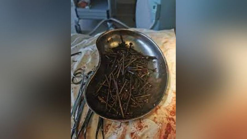 'Ufada  do`sti bilan garov bog`lagan odam sakkiz santimetrli mixlarni yutib yubordi'ning rasmi