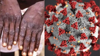 'Маймун чечаги одамдан одамга яхшироқ тарқала бошлади — иммунолог'ning rasmi