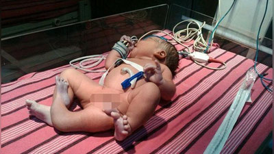 '​Hindistonda uch oyoqli qizcha tug`ildi'ning rasmi