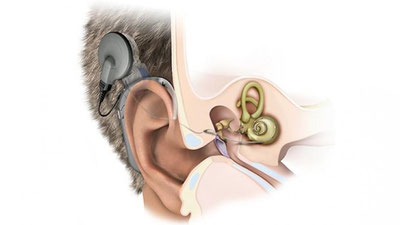 '6 ой ичида 5 ёшгача бўлган 164 нафар болада кохлеар имплантация амалиётлари ўтказилди'ning rasmi
