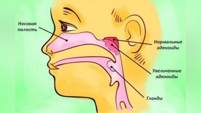 'Burundagi o`simta saratonga aylanishi mumkinmi?'ning rasmi