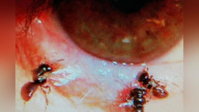 'Bemorning ko`zida tirik asalari borligi aniqlandi 'ning rasmi